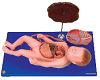 Fetus with Viscus and Placenta